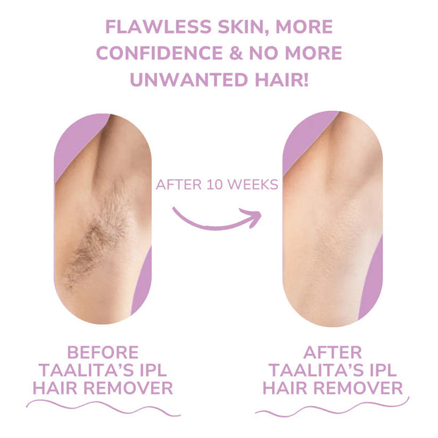 IPL Laser Hair Removal